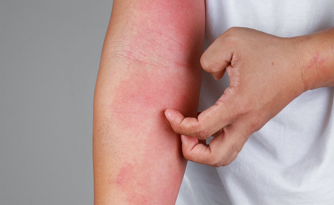 Dermatitis - Benefits of Tallow