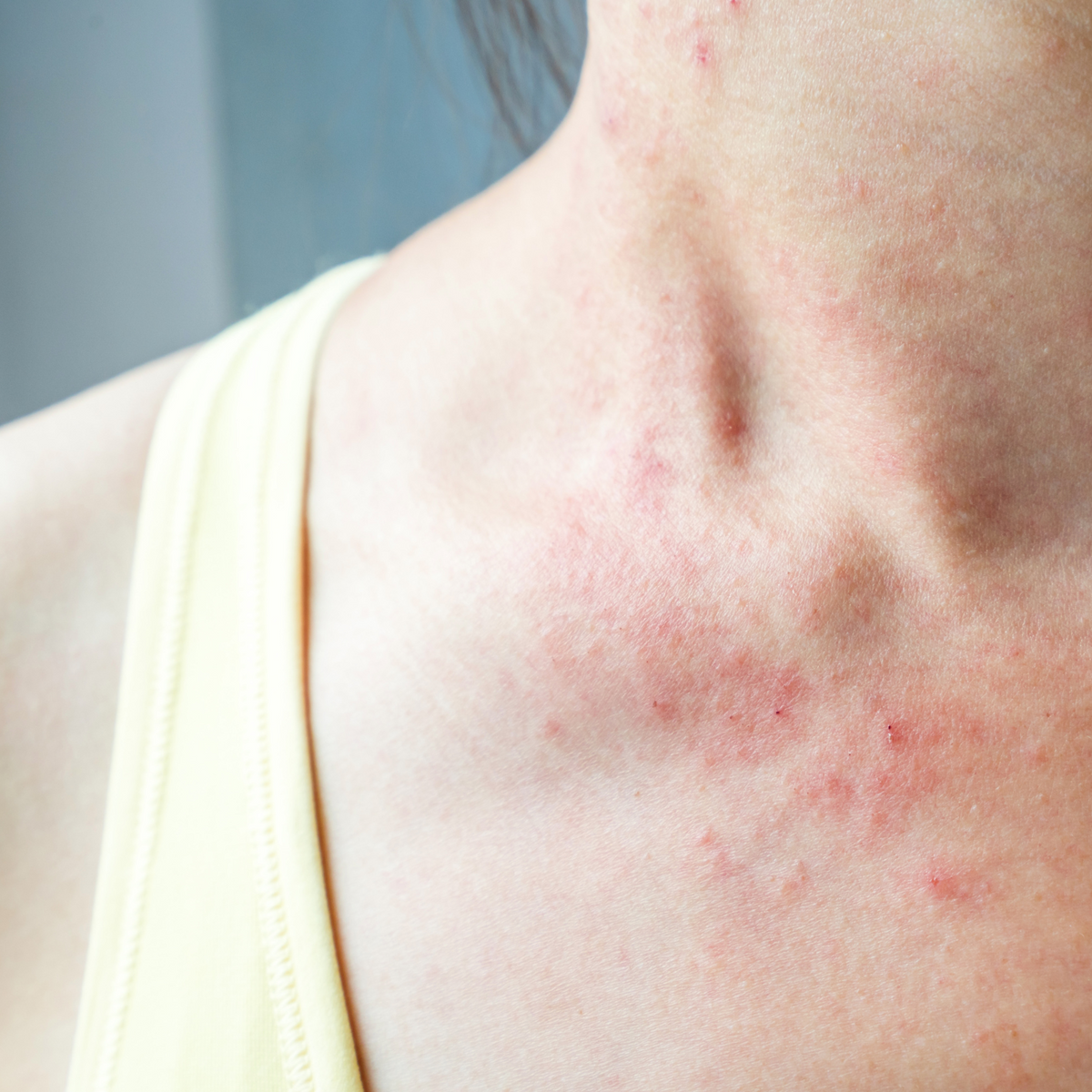 General Rash - Benefits of Tallow – Moo Organics Australia